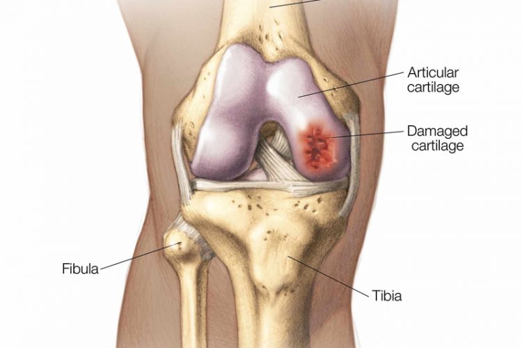 Arthroscopic Cartilage Regeneration Treatment